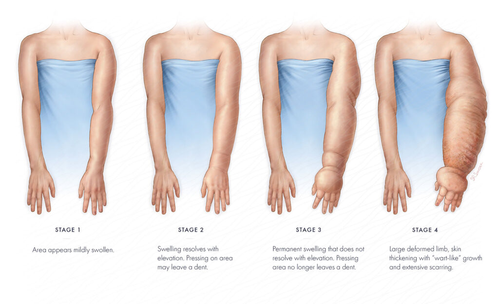 stages of lymphedema